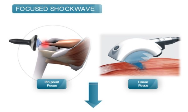 Chiropractic South Austin TX Shock Wave On Knee